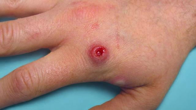 Înțelegerea variolei maimuțelor și cum să o preveniți?